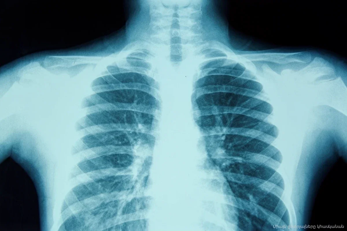 Нейросети научились подделывать рентген: врачи из 12 центров не узнали обман